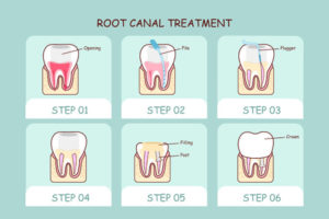 cartoon tooth root canal treatment , great for dental care concept