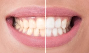 perfect smile before and after bleaching. dental care and whitening concept